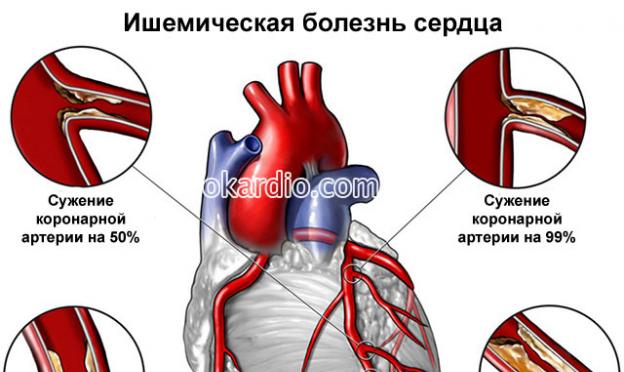 Боли в сердце: характер, причины, лечение